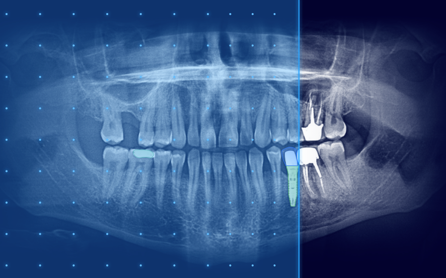 Analyse radio assistée par IA